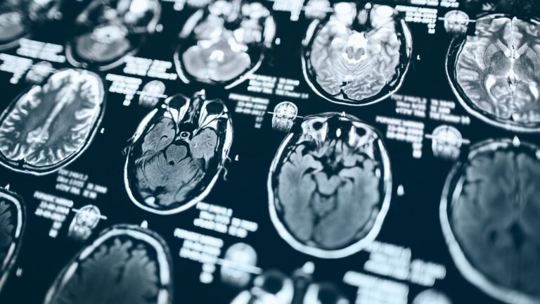 Plaintiff–Defense Brain Injury Litigation and the Measurement of Functional Loss: Medical Foundations, Expert Evidence, Trial Strategies